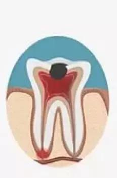 蛀牙补牙视频全过程,蛀牙不痛要做根管治疗吗