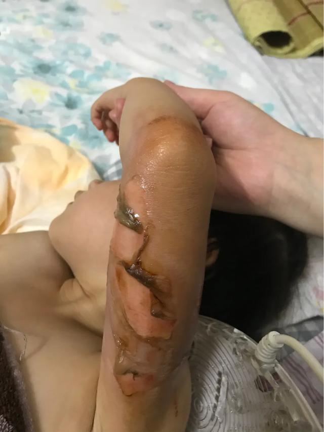 孩子大面积烫伤治疗流程,记录女儿被烫伤到治疗全过程