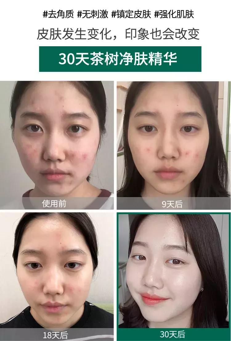 somebymi柚子精华可以祛痘印吗,茶树痘肌修复精华