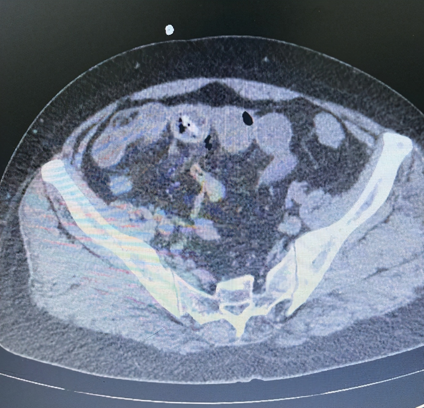 枣核致肠穿孔,腹腔镜胃穿孔手术