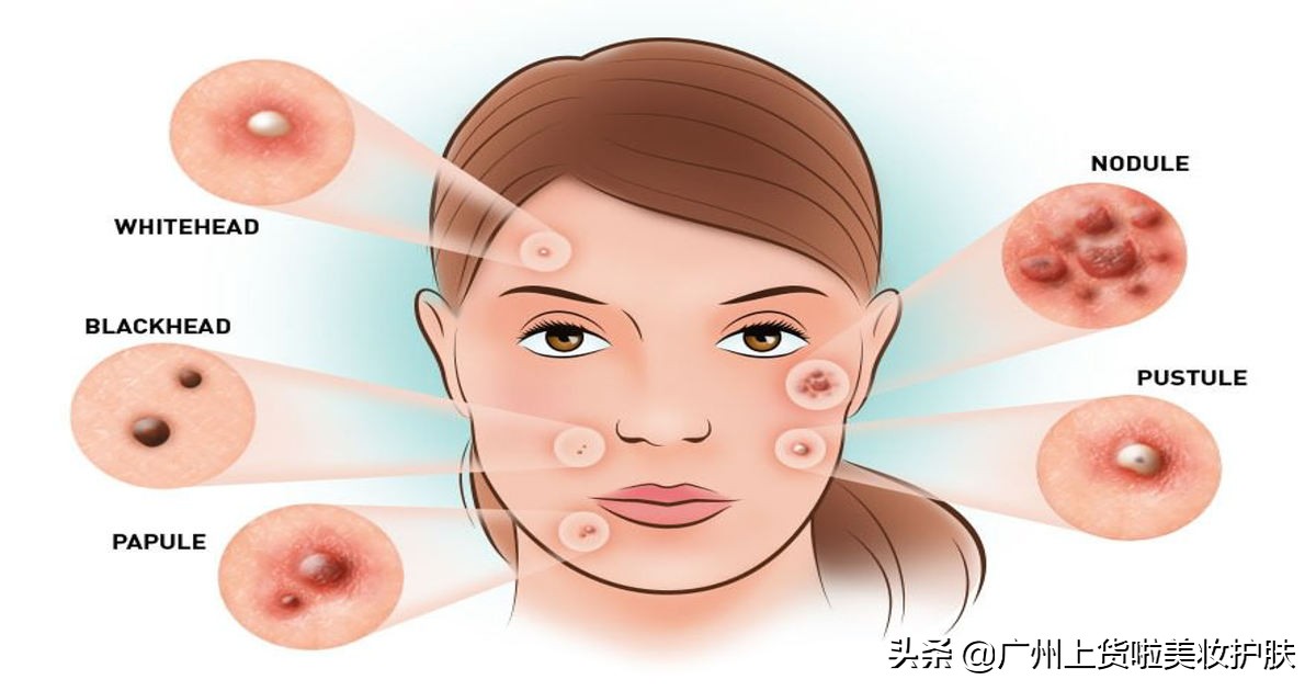 得了激素过敏性皮炎怎么办,得了激素性皮炎记住一停二忍三调