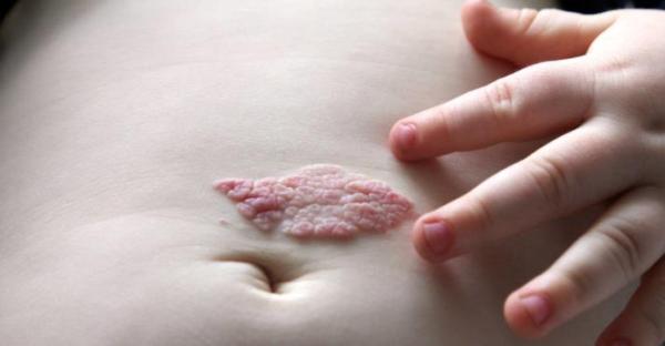 新生儿脸上身上长红斑怎么回事,身上脸上出红斑疙瘩吃什么药