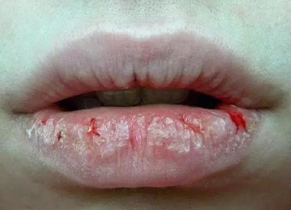 怀孕晚期嘴唇上得了血管瘤怎么办,孕妇嘴唇长血管瘤怎么办