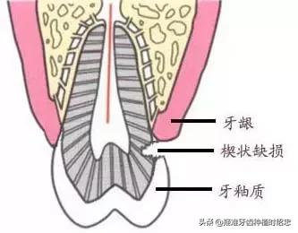 改变刷牙方式楔状缺损就会停止吗,刷牙导致楔状缺损牙齿会断么