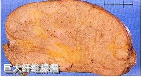 什么是乳腺纤维腺瘤？摸到乳房上有肿块，还不痛，就要小心了