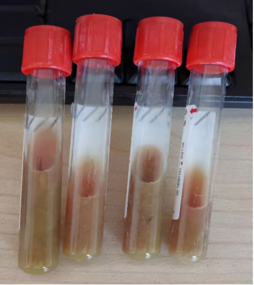 不做穿刺引流肝脓肿一般能好吗,大脑有囊肿需要做开颅手术吗