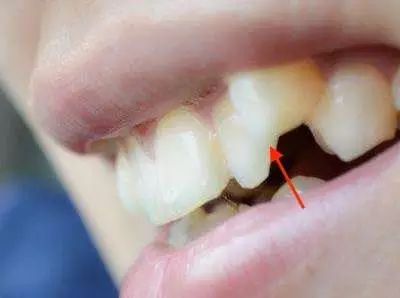 为什么吃东西会把牙磕掉,为什么吃东西后会牙齿出血呢