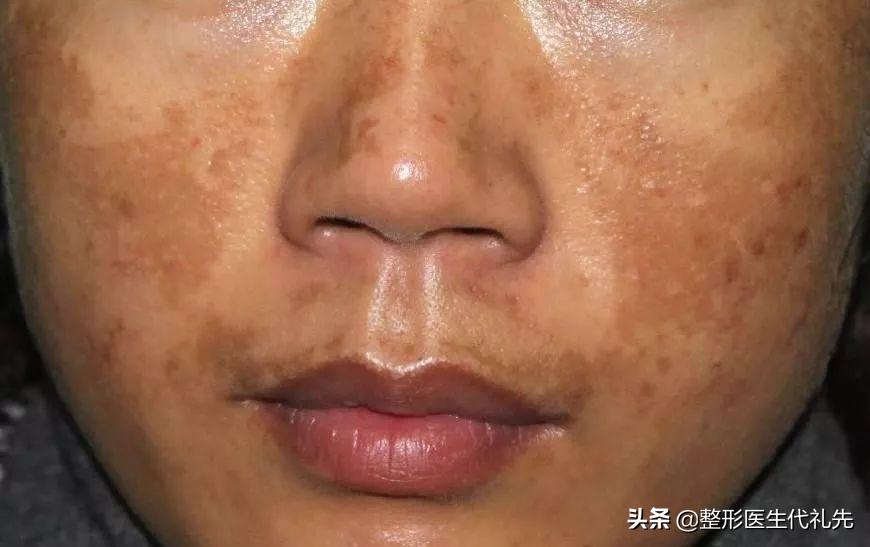 褐斑是什么病,褐斑形成原因