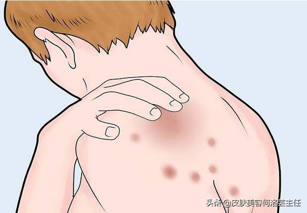 慢性荨麻疹治好了还需要忌口吗,麻疹怎么解释