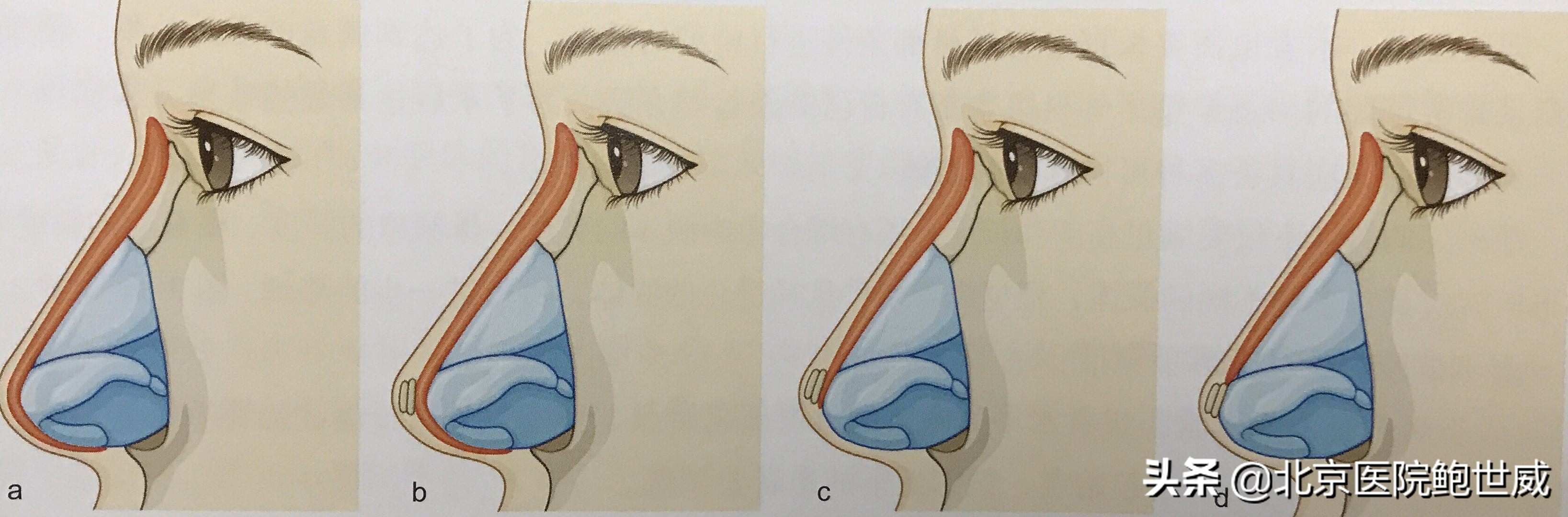 隆鼻后假体外露会有什么表现,假体隆鼻外露怎么修复