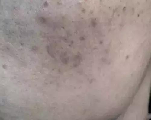 痘印祛痘药膏,痘印去除护肤品