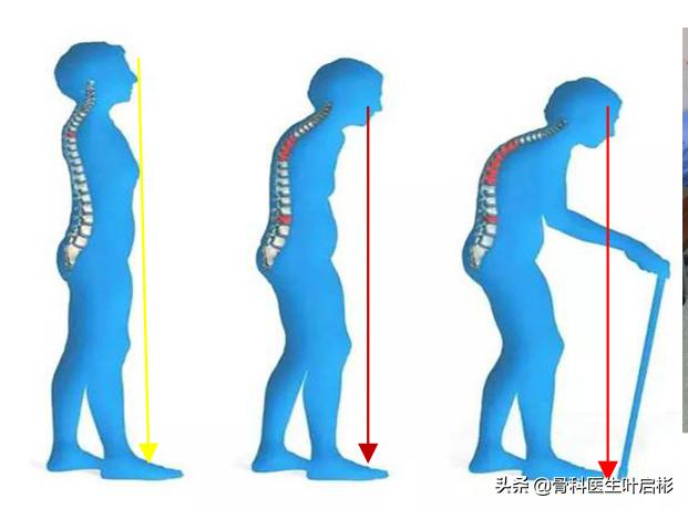 老年人骨折危险在哪里,如何辨别老年人是否骨折