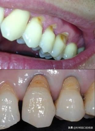 pmtc洗牙和普通洗牙有什么区别吗,39.9洗牙和150洗牙有什么区别