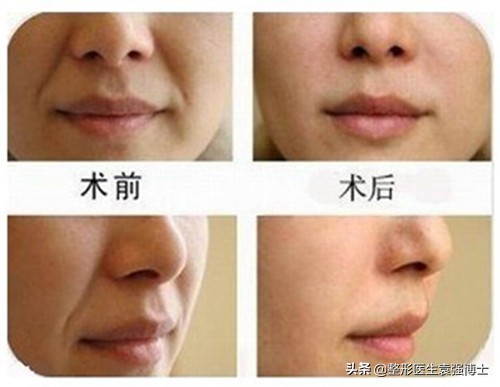 整形法令纹怎么去除最快最有效,整形医院可以去除法令纹吗