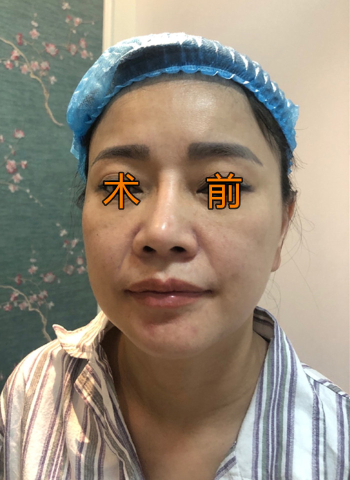 内窥镜无痕拉皮术,内窥镜脸部拉皮到底有多厉害