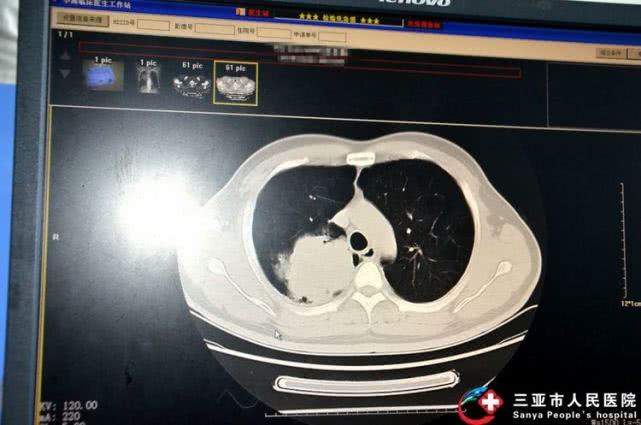三亚市人民医院成功开展海南省首例支气管镜下冷冻活检术
