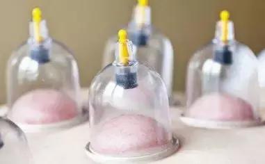 拔罐疗法的现代理论,拔罐是火罐还是真空罐好