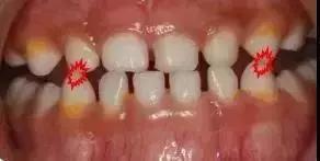 地包天早期矫正最佳时间,地包天10-15岁矫正是最佳年龄吗