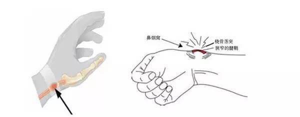 几个动作预防腱鞘炎（妈妈手），准妈妈必看