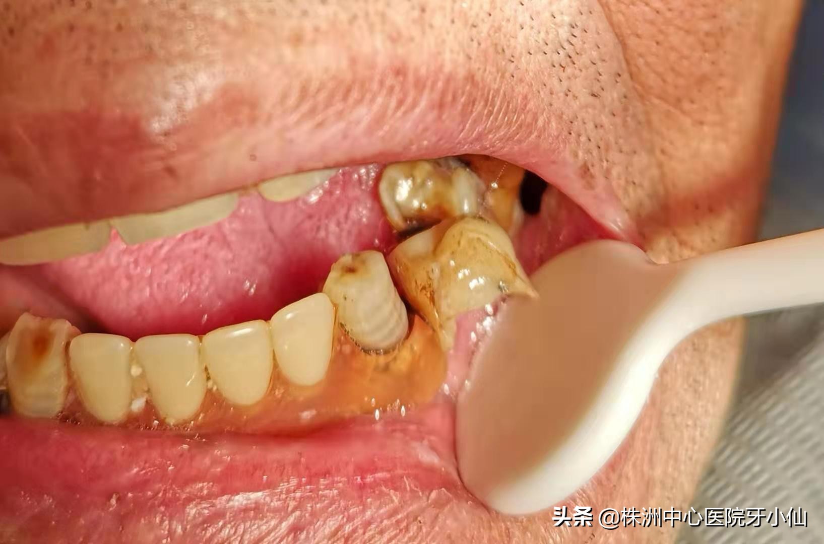 口腔白斑是白色念珠菌感染吗,口腔白斑和吃槟榔有关吗