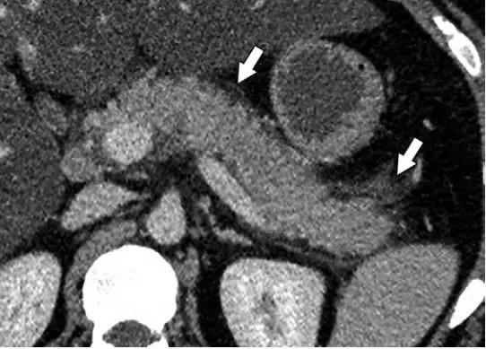 急性胰腺炎影像检查首选,急性坏死胰腺炎影像