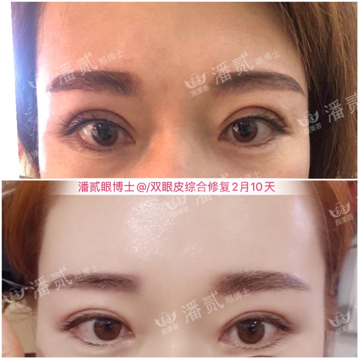 割双眼皮眼皮压下来会恢复吗,割双眼皮以后会松弛更快吗