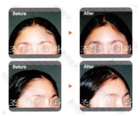 整形小腿肌肉切除,腿部整形手术好吗