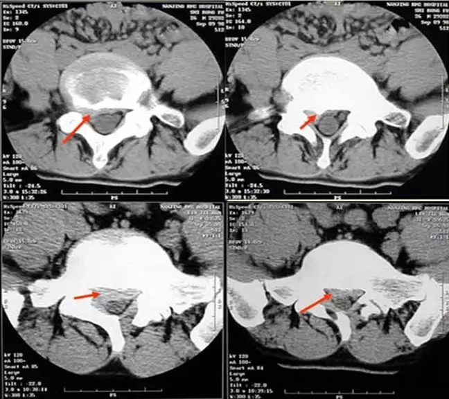 颈椎腰椎疾病ct及mri诊断,腰椎ct可以发现肠部病变吗