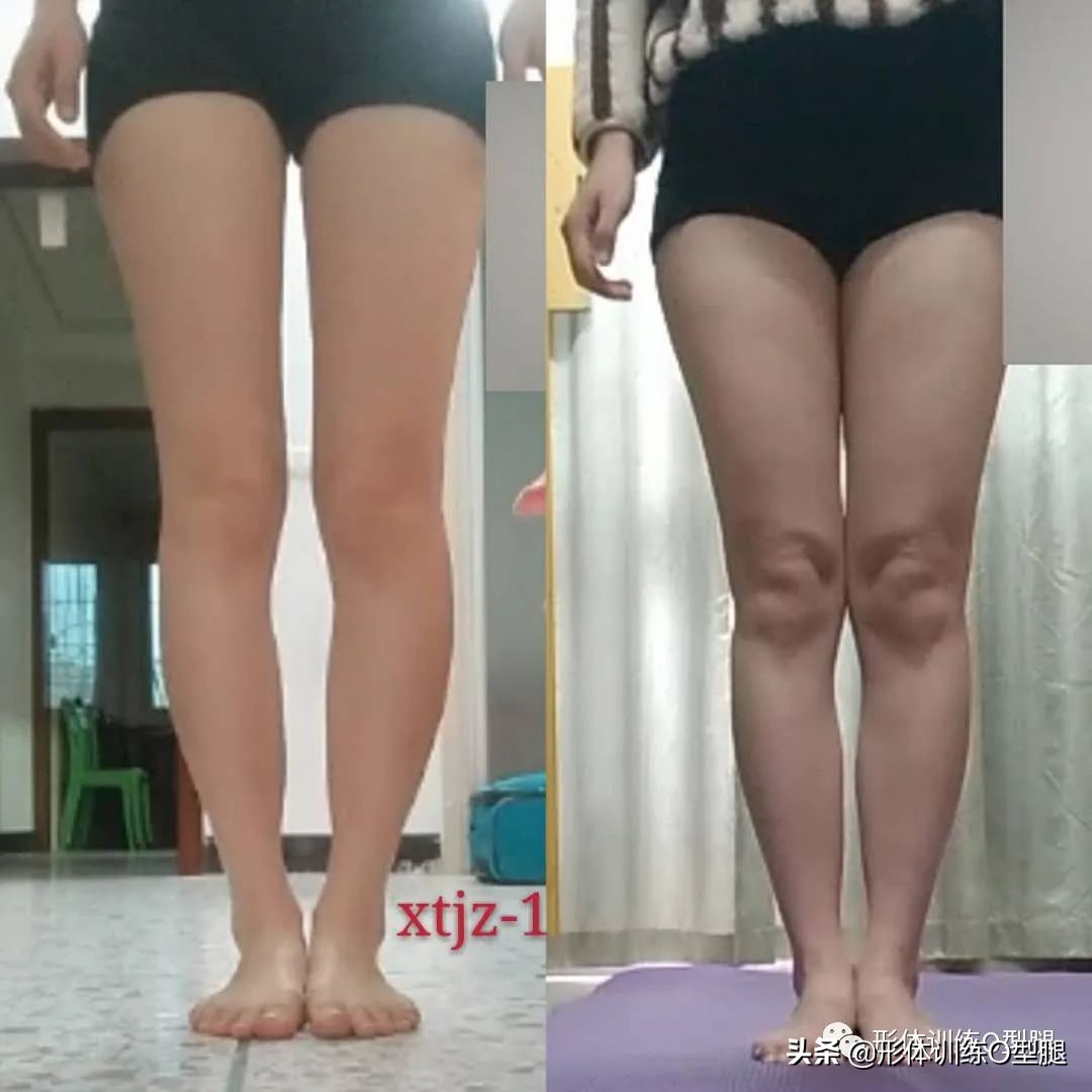 o型腿罗圈腿,后期形成的罗圈腿怎么自我矫正