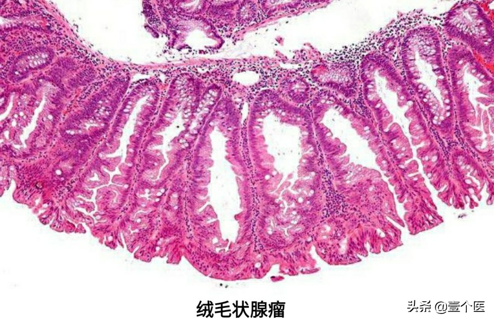 癌前病变非典型增生解释,病理出现原位癌和浸润性癌