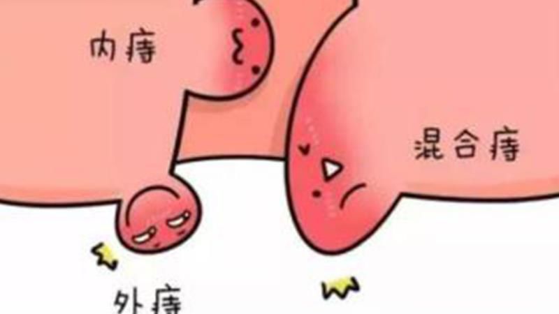 内痔混合痔有哪些症状,痔疮混合痔的病因