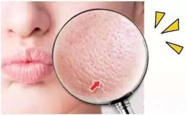 毛孔粗大怎么办教你一招根除,毛孔粗大怎么让毛孔变得细腻