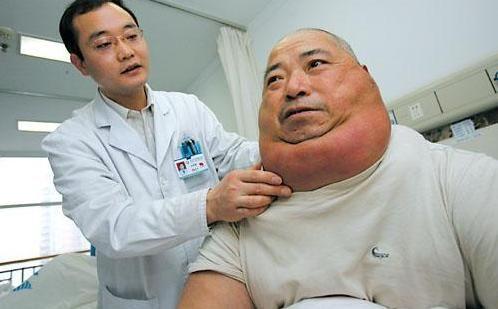 脂肪瘤癌变会怎样,脂肪瘤有癌变可能