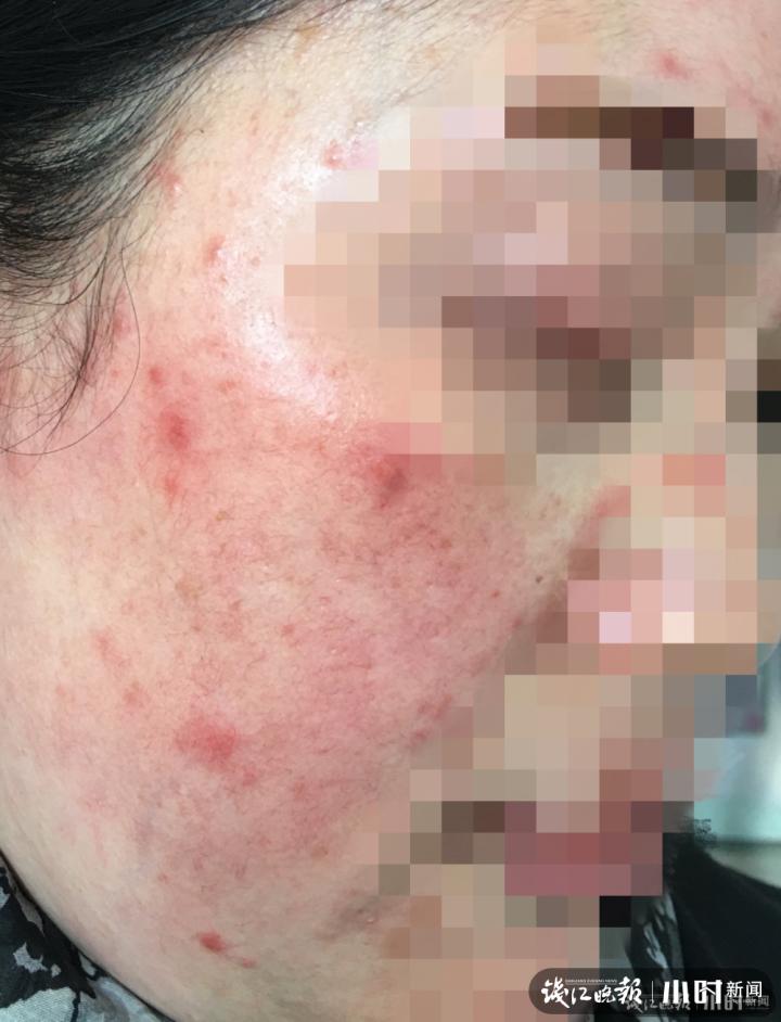 赶紧停用！女子突然“烂脸”，医生：每天接诊七八个