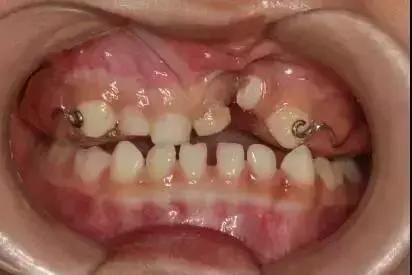 地包天早期矫正最佳时间,地包天10-15岁矫正是最佳年龄吗