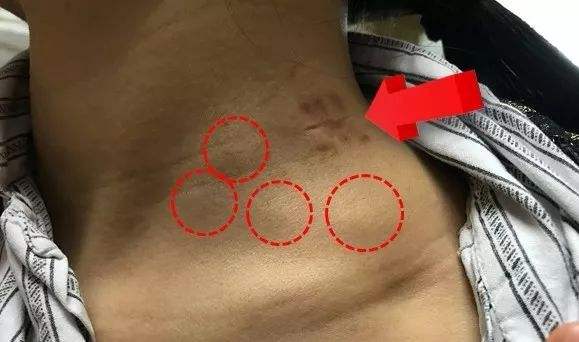 淋巴肿大怎么消除会引起发烧吗,淋巴结肿大可以做淋巴排毒吗