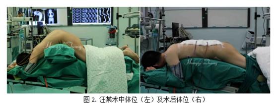 湘雅医院为重度强直性脊柱炎后凸畸形患者恢复“直立”人生