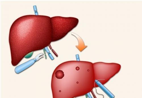 比乙肝厉害的肝病是什么,甲肝和乙肝丙肝的区别哪个危害大