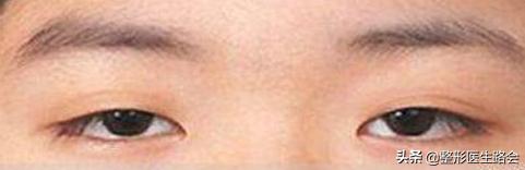 割双眼皮真的有效果吗,适合割双眼皮的眼部条件