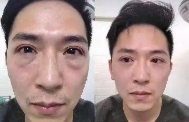 眼袋大显老试试这个方法简单实用,眼袋显老怎么办四种方法帮你去掉