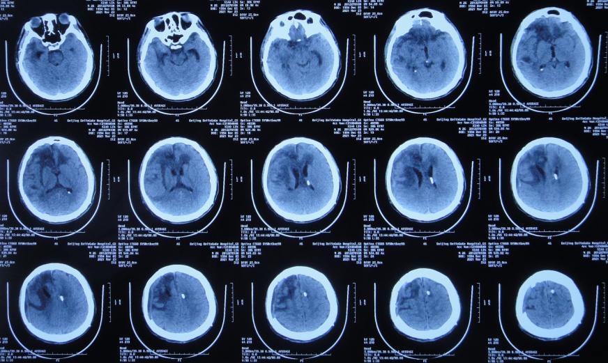 开颅手术后颅内细菌感染图片,外伤开颅手术后脑积液能恢复吗