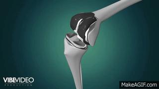 膝关节骨刺正确治疗方法,膝关节骨刺怎么缓解症状