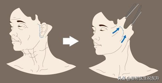 拉皮手术难度有多高,大拉皮手术做完前后对比图