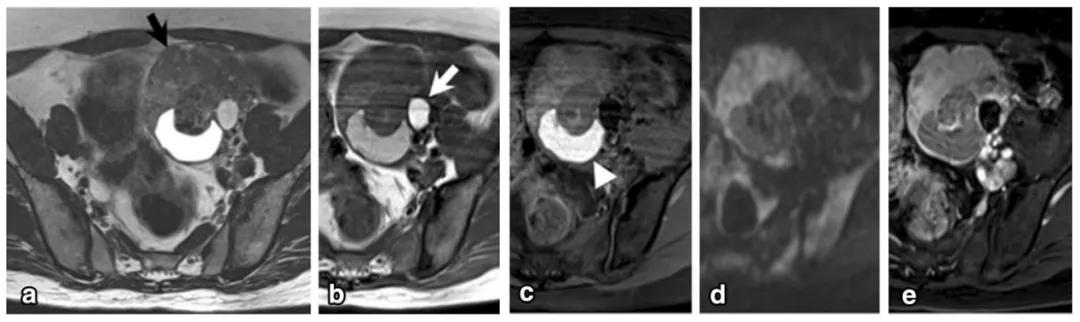 卵巢实性为主肿瘤，这13种你都想到了吗？