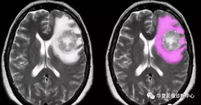 各型脑水肿影像及病理、生理解析
