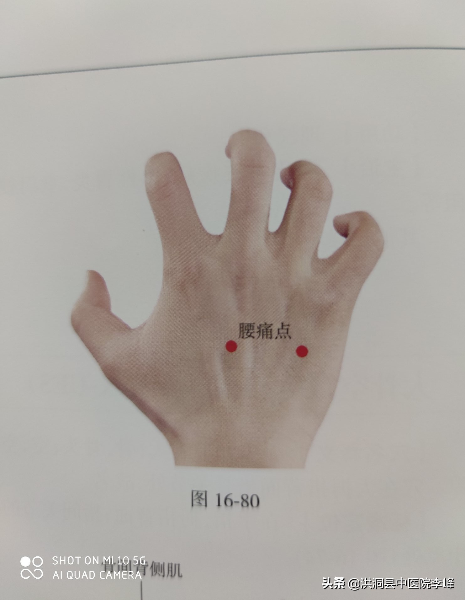 常见痛症“针刺运动疗法”特定取穴