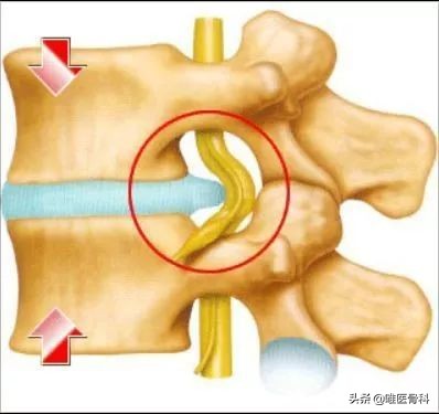 腰椎间盘突出手术后多久可以跑步,患了腰椎间盘突出还能跑步吗