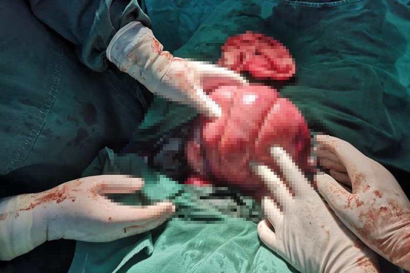 孕妇出血4000ml胎盘早剥霄边医院绿色通道成功救治后痊愈出院