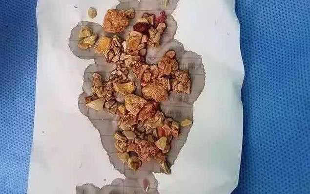 五个月宝宝添加辅食得了肾结石,3个月孩子吃辅食得肾结石