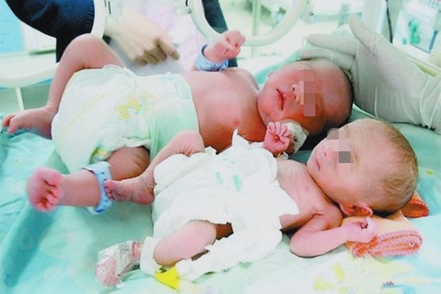 双胞胎输血综合症宝宝健康几率,双胎输血综合征28周早产宝宝